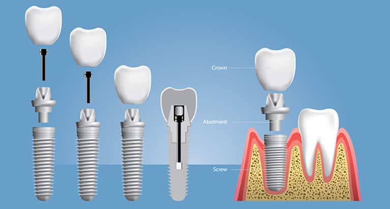 Dental Implants