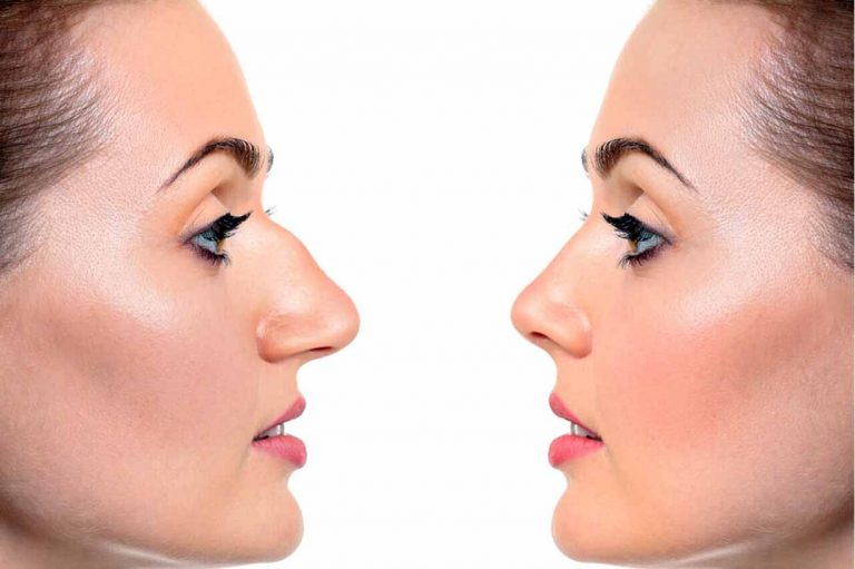 Rhinoplasty or nose job