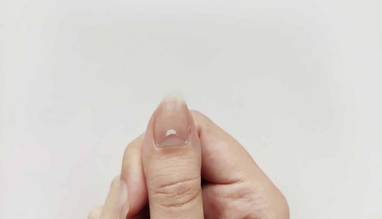 Symptoms of Nail Abnormalities