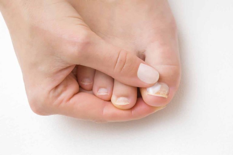 Nail Abnormalities: Symptoms, Causes, and Prevention