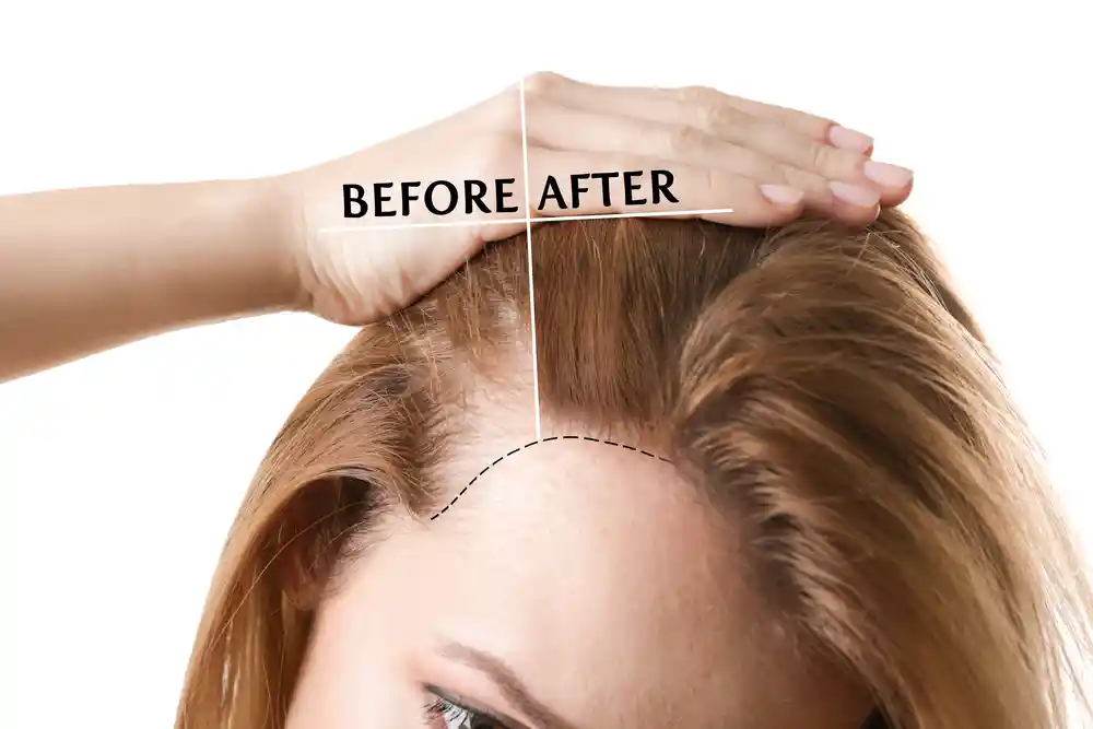 Female Hair Loss treatment
