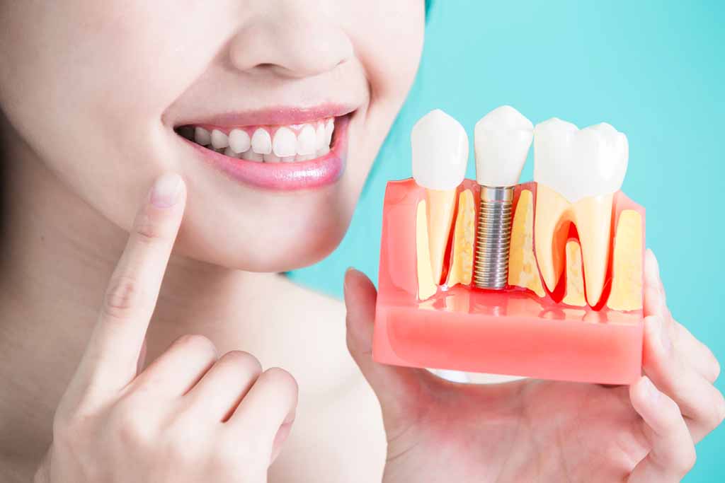 Implant-Supported Dentures Add Strength and Stability